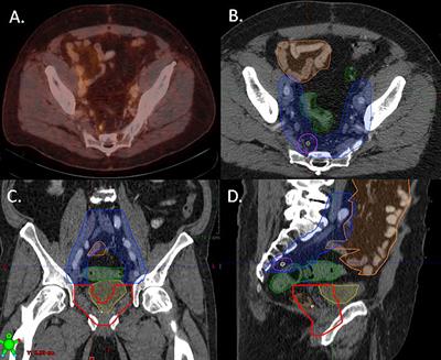 Combining 68Ga-PSMA-PET/CT-Directed and Elective Radiation Therapy Improves Outcome in Oligorecurrent Prostate Cancer: A Retrospective Multicenter Study